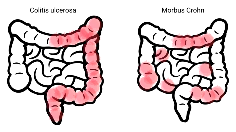 Illustration von zwei Därmen mit farblicher Markierung der entzündeten Abschnitte bei Morbus Crohn und Colitis ulcerosa. | © Stiftung MyHandicap / EnableMe